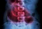 Bolsonaro internado de novo: o que é obstrução intestinal?